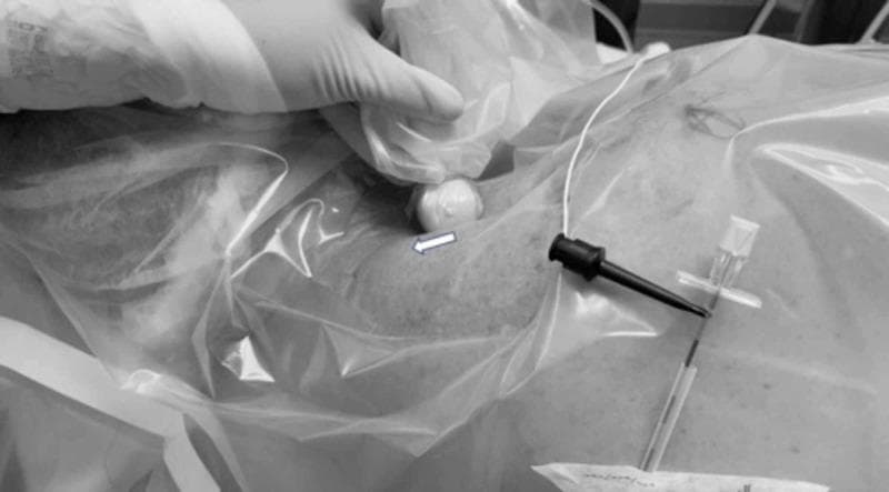This clinical photograph captures a regional anesthesia procedure, specifically an ultrasound-guided interscalene brachial plexus block at the level of the upper trunk. The image displays a sterilely prepared field covered by a transparent plastic drape. A clinician's gloved hand is visible on the left, manipulating an ultrasound probe that is sheathed in a sterile cover. An arrow indicates the cephalad rotation of the probe's lateral edge. To the right, a specialized regional anesthesia needle is inserted through the drape and into the skin in an in-plane orientation relative to the ultrasound beam. Visible components of the needle assembly include a clear hub with a white cap and a black stimulator connector, indicating the use of neurostimulation for nerve localization. The procedure demonstrates the lateral-to-medial advancement of the needle through the middle scalene muscle toward the upper trunk of the brachial plexus. This visual serves as an educational guide for probe orientation and needle-probe alignment during catheter placement for continuous peripheral nerve blocks.