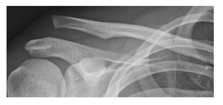 This diagnostic X-ray captures an anteroposterior (AP) view of the shoulder girdle, demonstrating a high-grade acromioclavicular (AC) joint dislocation, consistent with a Rockwood Type V injury. The primary pathological finding is a significant superior displacement of the distal clavicle relative to the acromion of the scapula. The normal alignment of the AC joint is completely disrupted, with the clavicle overriding the acromion and showing a markedly increased coracoclavicular distance, indicating complete rupture of both the acromioclavicular and coracoclavicular ligaments. Anatomical landmarks clearly visible include the clavicular shaft, the acromion process, the coracoid process, the glenoid fossa, and the proximal humerus (head and greater tuberosity). This image is essential for teaching orthopedic assessment of shoulder trauma, joint stability, and the radiographic classification of ligamentous injuries. It serves as a classic clinical example for medical students and residents studying musculoskeletal radiology and sports medicine.