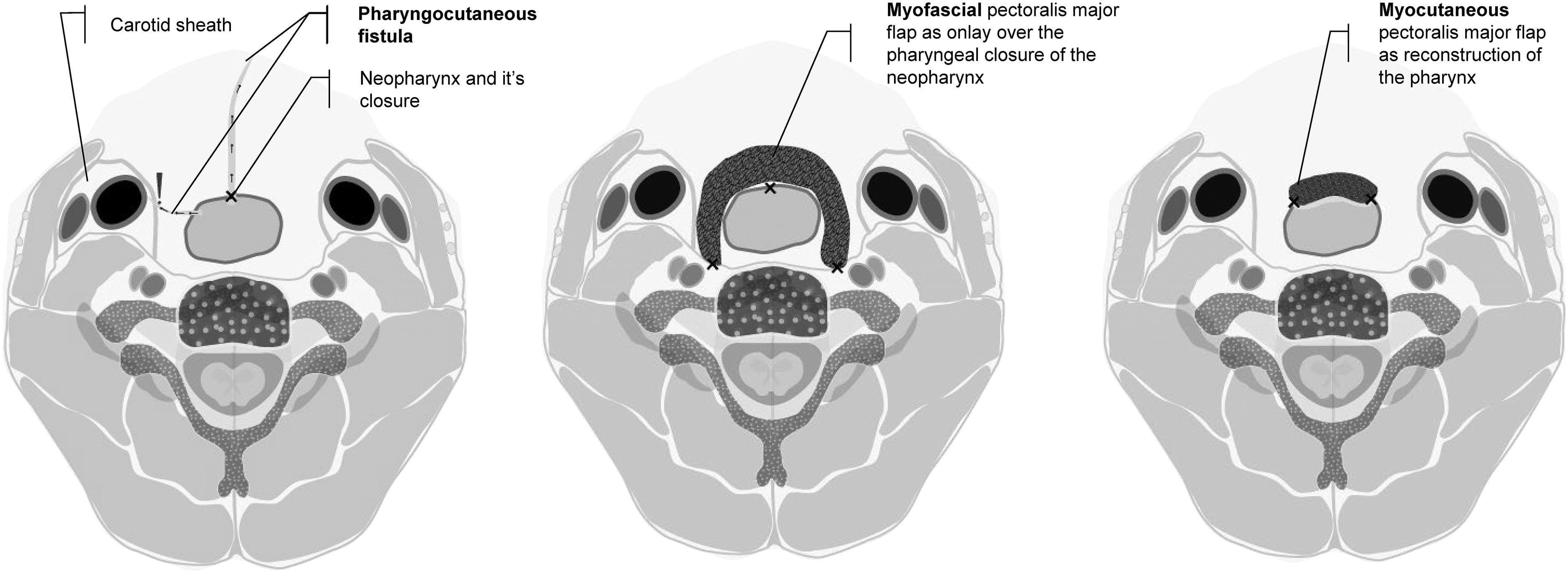 This medical illustration comprises three axial-view diagrams of the neck, demonstrating different stages and methods of surgical reconstruction following a total laryngectomy. The leftmost diagram highlights a common postoperative complication: a pharyngocutaneous fistula (PCF). It depicts the anatomical proximity of the neopharynx closure to the carotid sheath and illustrates the saliva-leaking pathway from the neopharyngeal lumen to the skin surface. The center diagram shows the prophylactic use of a myofascial pectoralis major flap (PMMF) applied as an 'onlay' reinforcement over the primary pharyngeal closure to prevent fistula formation. The rightmost diagram illustrates a more extensive reconstruction using a myocutaneous pectoralis major flap (PMMC) where the flap itself forms a significant portion of the reconstructed pharynx. Key anatomical structures visible in all views include the cervical vertebrae, spinal canal, and bilateral carotid sheaths containing the carotid artery and internal jugular vein. This comparison provides clinical insight into laryngeal cancer surgical sequelae and the use of vascularized muscle flaps in reconstructive head and neck surgery.
