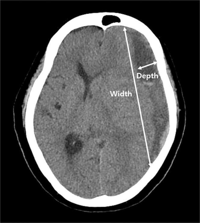 An axial non-contrast computed tomography (CT) scan of the head demonstrating a chronic subdural hematoma (SDH) located along the right convexity. The hematoma presents as a crescent-shaped, hypodense collection relative to the brain parenchyma, situated between the inner table of the skull and the brain surface. The image highlights the methodology for calculating depressed brain volume through two annotated measurements: 'Depth' and 'Width'. Depth is indicated by a short double-headed arrow representing the maximal transverse diameter between the inner skull table and the displaced brain surface. Width is indicated by a long double-headed arrow representing the linear distance between the superior and inferior margins where the hematoma meets the skull. The SDH causes visible mass effect, resulting in the effacement of cortical sulci and inward displacement of the underlying brain tissue. This visual serves as an educational reference for neuroradiological assessment of intracranial fluid collections and the quantitative evaluation of brain compression.