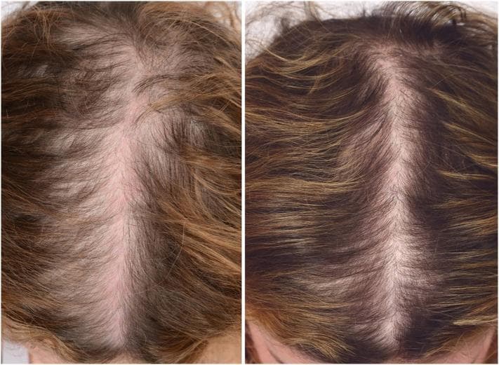 Clinical photograph showing a side-by-side comparison of the vertex and mid-scalp of a 46-year-old female patient with female pattern hair loss (androgenetic alopecia). The 'before' image (left) demonstrates diffuse thinning, characterized by a widened central part and increased scalp visibility, consistent with a Ludwig scale classification of hair loss. The 'after' image (right) displays the clinical outcome three months following three sessions of platelet-rich plasma (PRP) therapy. Visually, the 'after' state shows a significant increase in hair density, a narrowing of the central part line, and improved scalp coverage. The medical specialty is dermatology, focusing on trichology and non-surgical hair restoration. This comparison serves as an educational resource to illustrate the therapeutic potential of PRP in managing follicular miniaturization and increasing hair volume in patients with androgenetic alopecia.