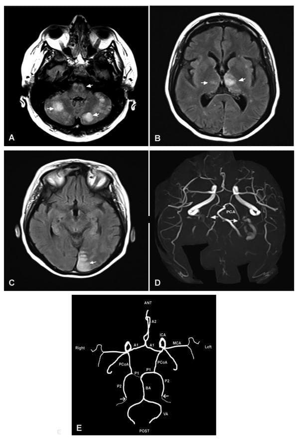 This composite figure illustrates an acute vertebrobasilar territory stroke using diagnostic imaging and anatomical diagrams. Panels A, B, and C are axial MRI (FLAIR/T2) images of the head demonstrating multiple areas of high signal intensity (hypersignal) representing ischemic infarcts. Specifically, panel A shows bilateral cerebellar and bulboprotuberancial junction involvement; panel B shows bilateral thalamic infarcts, more extensive on the left; and panel C shows an infarct in the left occipital lobe. Panel D is an MRI Time-of-Flight (TOF) angiography of the Circle of Willis, showing bilateral occlusion of the posterior cerebral arteries (PCA), marked by arrows. Panel E is a corresponding anatomical diagram mapping the patient's vascular configuration. It highlights a 'fetal type' right posterior communicating artery (PCoA) with a hypoplastic P1 segment of the PCA, where the right posterior territory is primarily supplied by the internal carotid artery (ICA). The diagram confirms the sites of bilateral distal occlusion (arrows) relative to the basilar artery (BA) and vertebral arteries (VA). This case demonstrates the clinical presentation of embolic stroke within the posterior circulation.