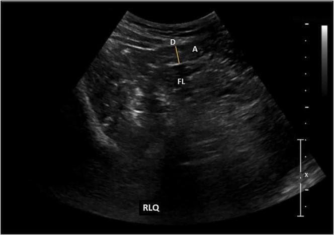 This diagnostic image is a B-mode grayscale abdominal ultrasound focusing on the right lower quadrant (RLQ). The image demonstrates a cross-sectional view of the vermiform appendix (labeled 'A'), appearing as a tubular, hypoechoic structure within the peritoneal cavity. A yellow measurement caliper ('D') indicates an outer diameter of 6 mm. Adjacent to the appendix, a small, localized periappendiceal fluid collection ('FL') is visible as an anechoic to hypoechoic area, suggesting localized inflammatory changes. The image quality allows for the differentiation of the appendix from surrounding soft tissue and bowel loops. This visual is clinically significant for the assessment of acute abdominal pain and the diagnostic evaluation of appendicitis. It serves as an educational example of RLQ sonography, illustrating target signs and fluid presence associated with inflammatory processes in the iliac fossa.