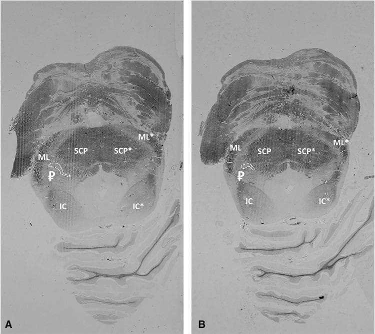 This diagnostic histological specimen showcases two transverse sections (A and B) of the human midbrain at the level of the inferior colliculus (IC), stained using a modified Heidenhain-Woelke method. This specific stain targets myelin, resulting in darkly stained white matter tracts and contrasting lighter, unstained gray matter structures. The sections highlight the neuroanatomical localization of the pedunculopontine nucleus (PPN), labeled with the symbol 'β½' and outlined in white. The PPN is visualized as an allantoid-shaped (sausage-shaped) gray matter region positioned between major white matter tracts: the medial lemniscus (ML) laterally and the superior cerebellar peduncle (SCP) medially. Section A represents a more cranial level, while Section B represents a more caudal level where the PPN's caudal apex is visible. Asterisks (*) denote left-sided neural structures. These sections serve as a gold-standard histological reference for identifying the PPN's boundaries, which are often poorly visualized on standard structural MRI.