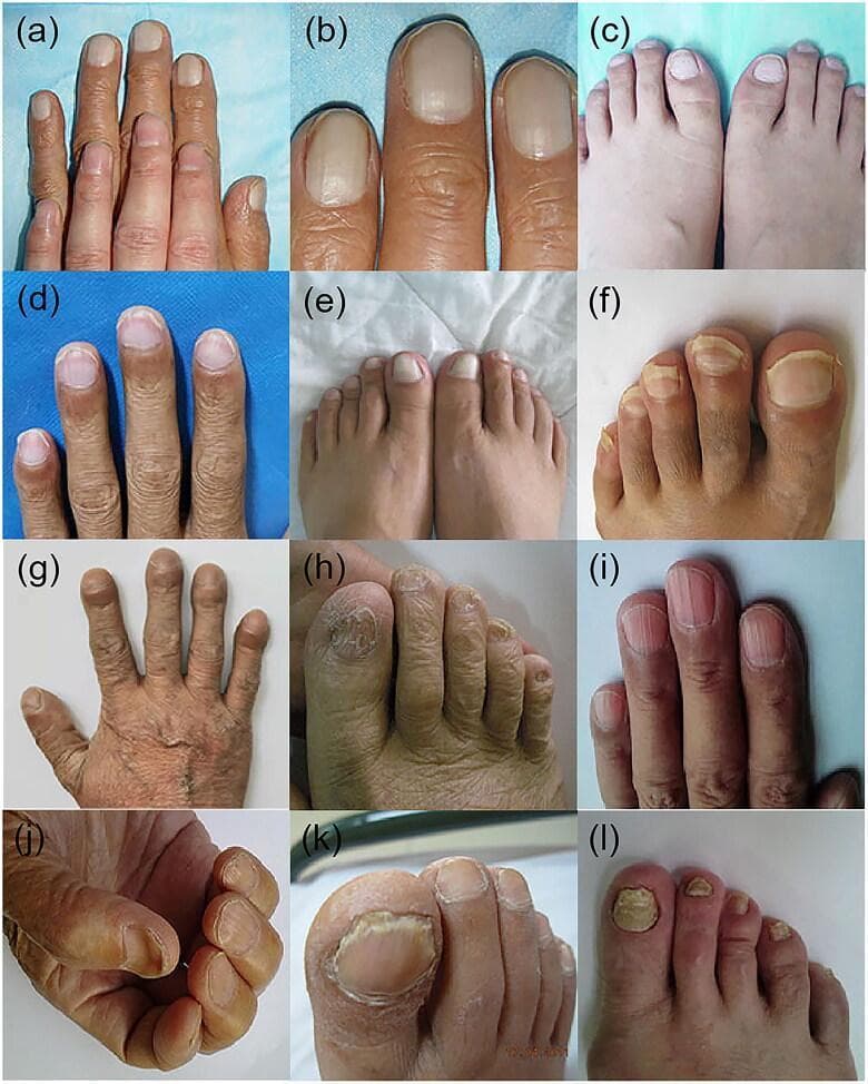 This composite clinical photograph displays multiple nail manifestations associated with systemic conditions, specifically chronic liver disease. The panel includes: (a-c) Terry's nails, showing a ground-glass whitening of the proximal nail bed with a narrow distal pink-brown band and absence of lunulae. (d) Lindsay's nails (half-and-half nails), featuring a sharp demarcation between a white proximal half and a reddish-brown distal half. (e) Leukonychia, characterized by total or partial whitening of the nail plate. (f) Onycholysis, demonstrating separation of the nail plate from the distal nail bed. (g) Clubbing, showing bulbous enlargement of the distal phalanges and increased nail curvature. (h) Brittle nails, exhibiting surface granulation and fragile, worn edges. (i) Longitudinal striations, presenting as prominent vertical ridges (onychorrhexis). (j) Koilonychia, showing characteristic concave or spoon-shaped nail plates. (k, l) Onychomycosis, illustrating fungal infection with subungual hyperkeratosis, yellow-white discoloration, and nail plate thickening. This collection serves as a diagnostic reference for dermatological signs of internal pathology, particularly hepatic cirrhosis and renal dysfunction.