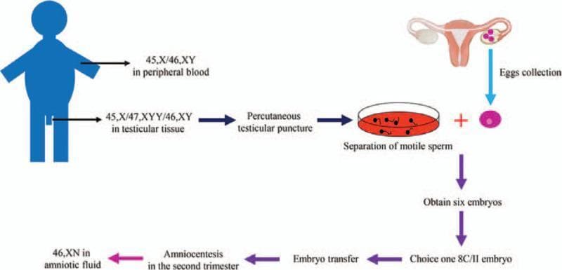 This medical flow diagram illustrates the clinical workflow of In Vitro Fertilization and Embryo Transfer (IVF-ET) in a case of male mosaicism. The process begins with a genetic evaluation of the male patient, showing a 45,X/46,XY karyotype in peripheral blood and a more complex 45,X/47,XYY/46,XY mosaicism in testicular tissue. The procedural steps follow: percutaneous testicular puncture for sperm retrieval, separation of motile sperm, and egg collection from the female reproductive system. These are combined to obtain six embryos, from which one '8C/II' embryo is selected for transfer. The final stages show the progression to pregnancy, including prenatal screening via amniocentesis in the second trimester, revealing a 46,XN karyotype in the amniotic fluid. This infographic serves as an educational tool for reproductive endocrinology and infertility (REI), demonstrating the management of gonadal dysgenesis and chromosomal mosaicism through assisted reproductive technology (ART) to achieve a successful pregnancy outcome.