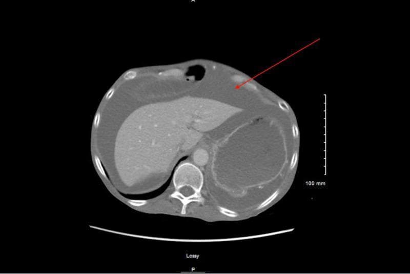 This diagnostic image is an axial computed tomography (CT) scan of the upper abdomen. The primary finding is a large-volume peritoneal effusion, or ascites, which appears as low-attenuation fluid (dark gray) surrounding the solid organs. A red arrow points specifically to the layering fluid between the liver and the anterior abdominal wall. The liver is visible in the right upper quadrant and exhibits a smooth contour with a relatively homogeneous parenchymal density, showing no overt signs of cirrhosis or focal masses. The spleen and a gas-distended stomach are visible on the left side of the frame, also surrounded by ascitic fluid. The fluid tracks into the paracolic gutters and the perisplenic space. Vertebral anatomy and a portion of the aorta are visible posteriorly. This image serves as a clinical example of high-protein or high-SAAG ascites, often associated with portal hypertension or cardiac etiology, demonstrated by the significant abdominal distension and fluid accumulation.