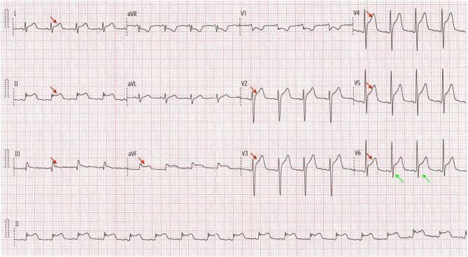 Hugging Face pmc clinical VQA raw