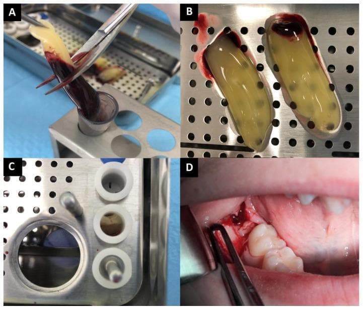 This composite intraoperative clinical photograph illustrates the preparation and application of Advanced Platelet-Rich Fibrin (A-PRF) in oral surgery. (A) Extraction of an A-PRF clot from a centrifugation tube using forceps, showing the distinctive separation between the translucent yellowish fibrin layer and the dark reddish-brown erythrocyte-rich base. (B) Two harvested A-PRF clots placed on a sterile metal tray; the clots exhibit a gelatinous, yellowish texture with a concentrated red corpuscle portion at one pole. (C) Preparation of A-PRF 'corks' within a dedicated PRF box, where the material is compressed into cylindrical shapes for easier socket insertion. (D) Intraoperative view of the A-PRF material being applied into a mandibular extraction socket. The reddish-brown fibrin material is seen packed into the surgical site adjacent to existing molars to promote wound healing and bone regeneration. The sequence demonstrates the autologous blood processing technique used to enhance postoperative recovery and reduce complications like dry socket or excessive pain in dental surgery.