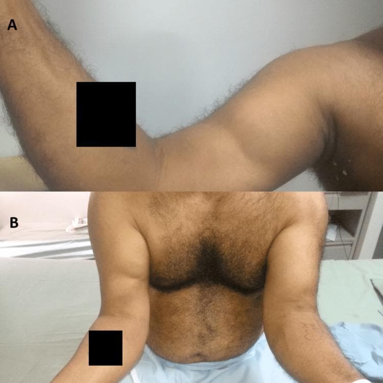 Clinical photograph of a 48-year-old male demonstrating a 'reverse Popeye sign' characteristic of a distal biceps tendon rupture. Panel A shows a lateral view of the flexed right arm, where the biceps brachii muscle belly is retracted proximally toward the shoulder, creating a prominent bulge in the upper arm and an abnormal depression near the antecubital fossa. Panel B provides a comparative frontal view of both upper extremities. The right arm exhibits significant muscular asymmetry compared to the normal left arm; the right biceps muscle mass is bunched and shifted superiorly, whereas the left arm shows normal muscle distribution along the humerus. This visual finding indicates a complete avulsion of the distal biceps tendon from its insertion on the radial tuberosity, leading to proximal retraction of the muscle. The image is a classic representation of soft tissue orthopedic trauma and is used to teach clinical diagnostic signs for tendon injuries in the musculoskeletal system.