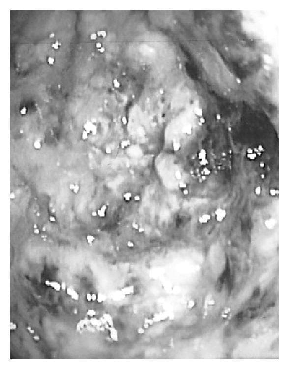 This diagnostic image is a monochrome still from a colonoscopy demonstrating severe pseudomembranous colitis, typically associated with Clostridioides difficile infection. The visual shows the internal mucosal surface of the colon, which is significantly inflamed and lacks the smooth, glistening appearance of healthy tissue. Numerous elevated, plaque-like pseudomembranes are visible as pale, whitish-yellow patches scattered across the roughened and congested colonic mucosa. These pseudomembranes consist of inflammatory exudate including fibrin, mucus, and necrotic debris. Small, bright highlights (specular reflections) from the endoscope's light source are visible across the damp surface. The image highlights key features of antibiotic-associated colitis, including mucosal disruption and characteristic pseudomembrane formation, serving as a critical clinical reference for gastroenterology and infectious disease education.