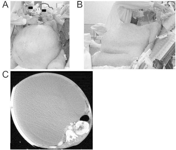 This composite image consists of clinical photographs and a diagnostic scan illustrating a massive abdominal distension. Panels A and B are preoperative clinical photographs in frontal and lateral views, respectively, showing a female patient with extreme abdominal enlargement. Visible clinical signs include taut, shiny skin and prominent, dilated subcutaneous veins (caput medusae) across the abdominal wall. The lateral view demonstrates the significant anterior protrusion of the abdomen, necessitating a semirecumbent position. Panel C is an axial abdominal computed tomography (CT) scan that confirms the etiology as a giant cystic mass occupying nearly the entire abdominal cavity. The mass is homogeneous and well-defined, severely compressing and displacing intra-abdominal viscera, including the bowel and kidneys, against the spine and posterior abdominal wall. This case demonstrates the clinical and radiological presentation of a giant ovarian tumor, highlighting its impact on abdominal anatomy and the potential for respiratory compromise due to diaphragmatic elevation.