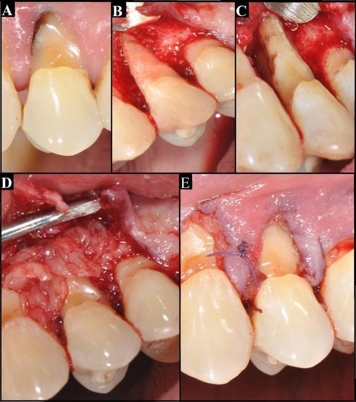 A series of five intraoral clinical photographs (A-E) documenting a periodontal surgical procedure for bone resorption and furcation involvement. Image A shows the preoperative state of a tooth with a deep abfraction—a wedge-shaped, dark-pigmented cervical lesion at the cementoenamel junction. Image B illustrates the vestibular aspect following the elevation of a full-thickness mucoperiosteal flap, revealing extensive alveolar bone resorption. Image C provides a mesial view of the exposed roots, highlighting Class II or III furcation involvement and total bone loss on the mesial-vestibular aspect. Image D demonstrates the application of Leukocyte-Platelet-Rich Fibrin (L-PRF) concentrate, where fibrin membranes are layered over the root surfaces to promote tissue regeneration. Image E shows the final surgical stage with the repositioned soft tissue flap secured by interdental polyglactin (Vicryl) sutures. This sequence illustrates advanced periodontal management using regenerative biomaterials to address significant attachment loss and osseous defects.