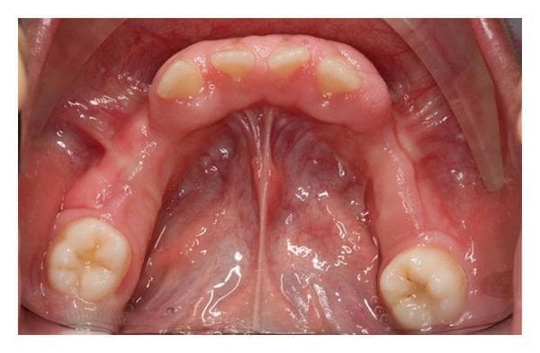 This intraoral clinical photograph provides an occlusal view of the mandibular arch in a 9-year-old pediatric patient, demonstrating generalized, severe gingival enlargement. The gingival tissue is pale pink, firm, and fibrotic in appearance, with a notable lack of inflammatory signs such as edema or bleeding. The overgrowth is most prominent in the anterior labial and lingual regions, where it significantly covers the clinical crowns of the incisors, appearing to displace them. The enlargement extends posteriorly, obscuring the alveolar ridge and surrounding the partially erupted molars. The tissue surface appears relatively smooth with diminished stippling. This presentation is consistent with hereditary gingival fibromatosis, characterized by non-hemorrhagic, slow-growing gingival hypertrophy that can interfere with tooth eruption, dental alignment, and aesthetics. The image serves as a clinical example of idiopathic or hereditary gingival overgrowth in a pediatric context.