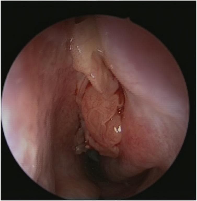 This clinical diagnostic image is an endoscopic view of the nasal cavity showing a large, fleshy, intranasal mass consistent with a sinonasal inverted papilloma. The mass is primarily pinkish-red and exhibits a distinctively lobulated, cerebriform surface texture with irregular folds and crevices. Occasional translucent or whitish spots are visible on its surface. The lesion originates from the lateral nasal wall or middle meatus and occupies a significant portion of the nasal passage, causing mechanical obstruction. The surrounding nasal mucosa appears erythematous. This visual is characteristic of inverted papilloma, a benign but locally aggressive neoplasm known for its high recurrence rate and risk of malignant transformation. The image serves as an educational example of otolaryngological endoscopy for diagnosing obstructive sinonasal tumors and differentiating them from simple inflammatory polyps.