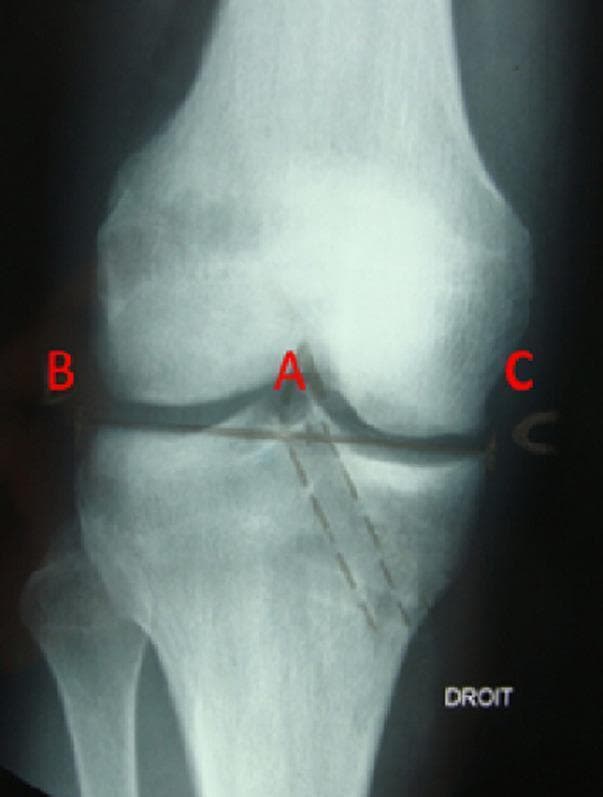 This anterior-posterior (AP) radiograph of a human right knee demonstrates a post-operative assessment of an anterior cruciate ligament (ACL) reconstruction. The image focuses on the evaluation of the tibial tunnel position using the Romano method. Key anatomical structures visible include the distal femur, proximal tibia, fibula, and the knee joint space. A radiolucent tibial tunnel is clearly visible, demarcated by dashed lines, following an oblique trajectory from the medial aspect of the proximal tibia toward the intercondylar eminence. Lettered annotations (A, B, and C) facilitate the measurement of the tunnel's exit point relative to the tibial plateau's width (B-C). Specifically, point A indicates the center of the tunnel's articular exit near the medial tibial spine. Surgical hardware, likely representing metallic staples or sutures, is faintly visible near the joint line and lateral femoral cortex. This diagnostic image is used in orthopedic surgery to ensure anatomical tunnel placement, which is critical for graft isometricity and preventing post-operative graft impingement or failure.