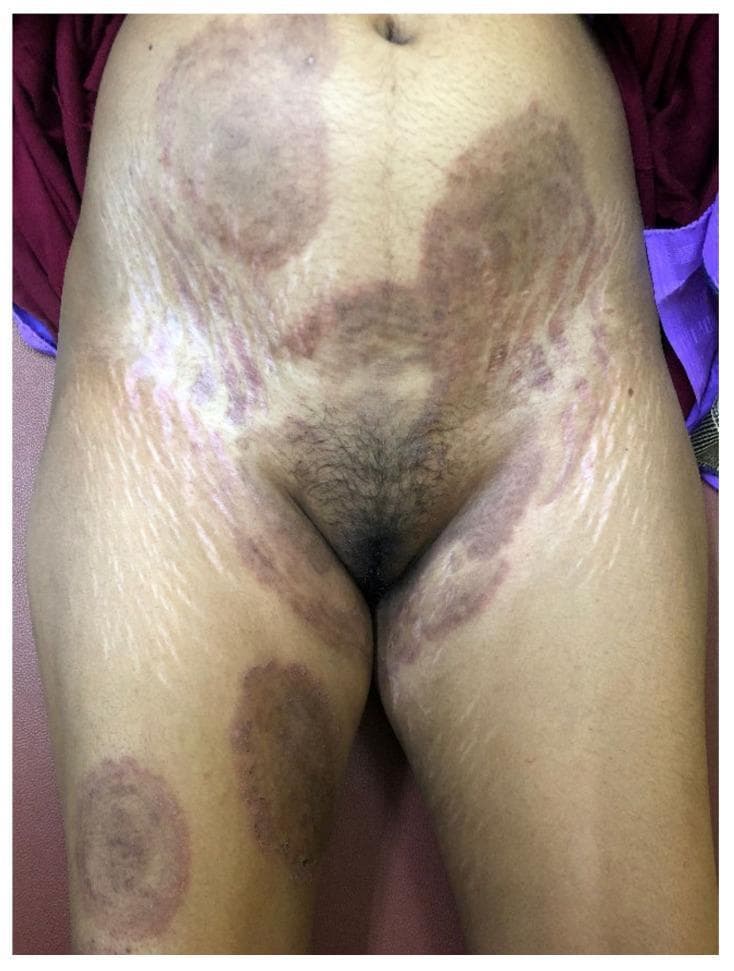 This clinical photograph shows the lower trunk, groin, and upper thighs of a patient exhibiting extensive dermatophytosis and secondary skin changes. Several large, erythematous, and hyperpigmented plaques are visible across the abdomen and inner thighs, characteristic of tinea corporis and tinea cruris. Notably, on the right thigh, a plaque displays a 'tinea pseudoimbricata' pattern, characterized by multiple concentric annular rings. Other areas show 'tinea recidivans,' where active inflammatory margins appear within previously healed sites. Superimposed on these fungal lesions are prominent cutaneous signs of corticosteroid misuse, specifically striking striae albae (white linear stretch marks) and patchy hypopigmentation, particularly dense along the lateral abdomen and inguinal folds. These atrophic changes indicate chronic application of high-potency topical fixed-dose combinations (FDCs). The image demonstrates the complex presentation of steroid-modified tinea (tinea incognita) caused by Trichophyton indotineae, highlighting the visual intersection of recalcitrant fungal infection and iatrogenic skin damage.