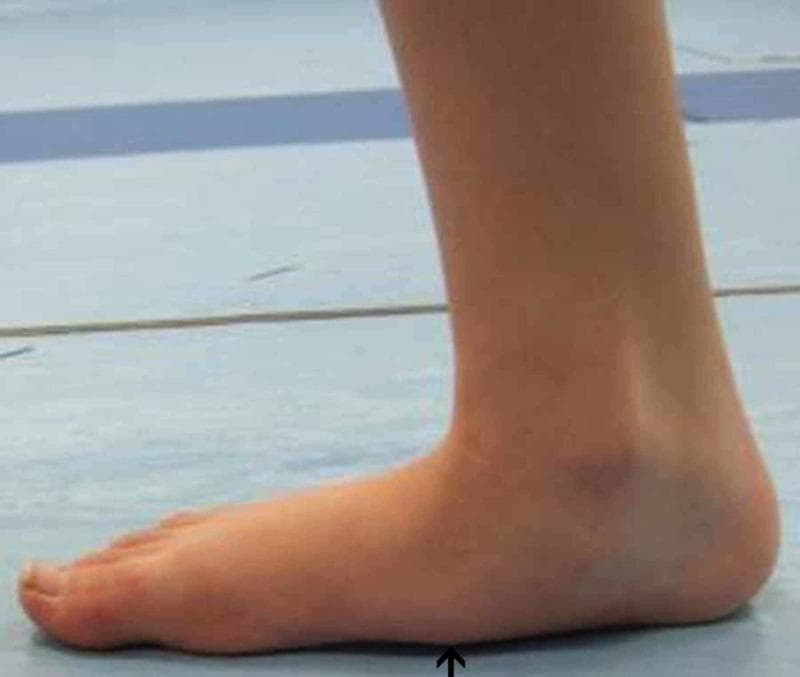 This clinical photograph displays a medial-side view of a right foot during a pre-operative gait analysis, illustrating significant musculoskeletal deformity. The primary visible feature is the complete flattening of the medial longitudinal arch, a condition known as pes planus (flat foot). The medial border of the foot shows direct contact with the weight-bearing surface, indicated by a black arrow pointing to the collapsed arch region. Additionally, there is a visible inward tilting of the ankle and outward displacement of the heel, characteristic of a valgus hindfoot deformity (pes planovalgus). This image serves as a clinical representation of pediatric or adult acquired flatfoot deformity, demonstrating the associated pronated posture and the loss of normal anatomical curvature. It is intended for educational use in podiatry, orthopedics, and physical therapy to identify the visual markers of arch collapse and hindfoot malalignment before surgical intervention.