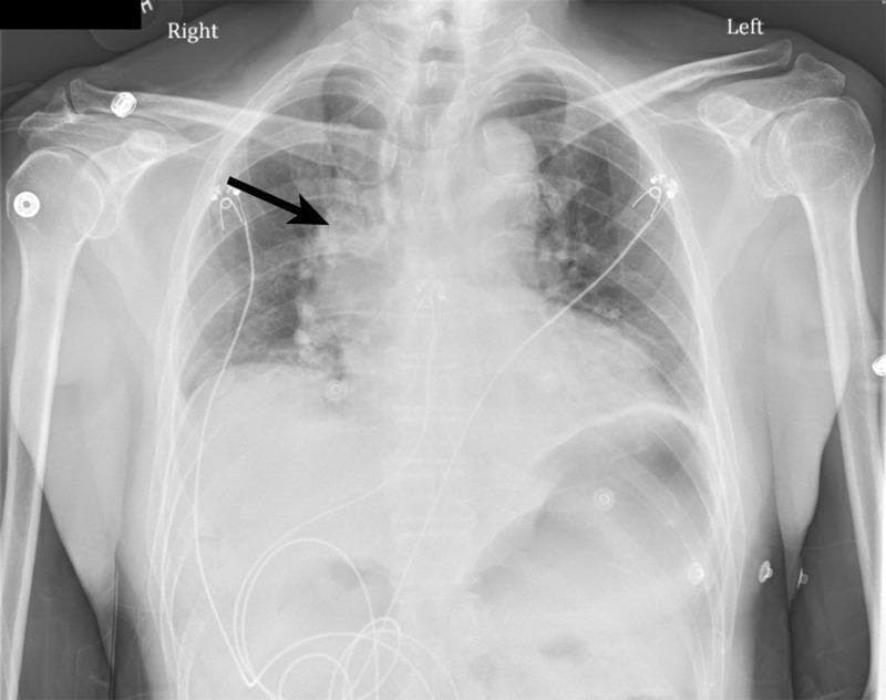 This diagnostic image is a posteroanterior (PA) chest X-ray illustrating thoracic anatomy and specific pathological findings. The primary focus is indicated by a black arrow pointing to significant right hilar fullness, characterized by increased density and enlargement of the right hilar region compared to the left. The lung fields demonstrate bibasal opacities consistent with atelectasis, more prominent at the lung bases bilaterally. Anatomical structures including the clavicles, ribs, humeri, and cardiac silhouette are visible. Multiple medical artifacts are present, specifically several EKG leads and associated wires overlaying the chest and abdominal regions, along with a possible central venous catheter. The image serves as a clinical example of hilar prominence and pulmonary atelectasis within the context of emergency or acute care medicine. The positioning and presence of monitoring equipment suggest an inpatient or acute clinical setting. This visual material is intended for intermediate medical education regarding the interpretation of thoracic radiographs and identifying hilar abnormalities.