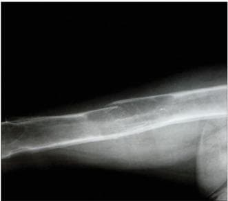 This diagnostic x-ray radiograph of the femur illustrates classic skeletal manifestations of secondary hyperparathyroidism. The femoral diaphysis exhibits a pathological fragility fracture occurring through a prominent brown tumor. This lesion is characterized by a focal area of altered bone density, showing both osteolytic bone destruction and attempts at new bone formation. Additionally, in the distal region of the femur, two further brown tumors are visible as well-defined, expansible, radiolucent lesions that clearly demarcate themselves from the surrounding cortical and medullary bone. The presence of these multiple osteoclastic giant-cell tumors (brown tumors) and the resulting fracture demonstrate the severe cortical thinning and reduced bone integrity associated with advanced metabolic bone disease. The image is a critical educational resource for identifying renal osteodystrophy and the radiological hallmarks of hyperparathyroidism in a clinical setting.
