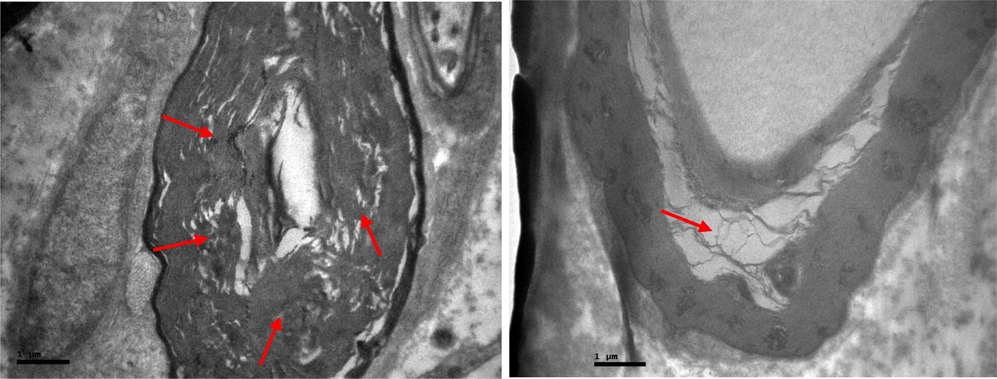 Two high-magnification transmission electron microscopy (TEM) micrographs depicting cross-sections of the femoral nerve showing advanced degenerative changes in the myelin sheath. The images demonstrate significant myelin disorganization and pathological vacuolization, highlighted by red arrows. In the left panel, the myelin sheath surrounding the axon appears thickened and fragmented, with loss of the normal compact lamellar structure. The right panel provides a closer view of focal vacuolization, where the myelin layers have separated to form clear, empty intra-myelinic spaces. These structural alterations represent demyelinating processes and nerve fiber degradation. Scale bars are provided at 1 μm. This visual content is used for neuropathology studies to illustrate pharmacological or traumatic effects on peripheral nerve integrity, specifically focusing on myelin sheath morphology and axon-myelin relationship.