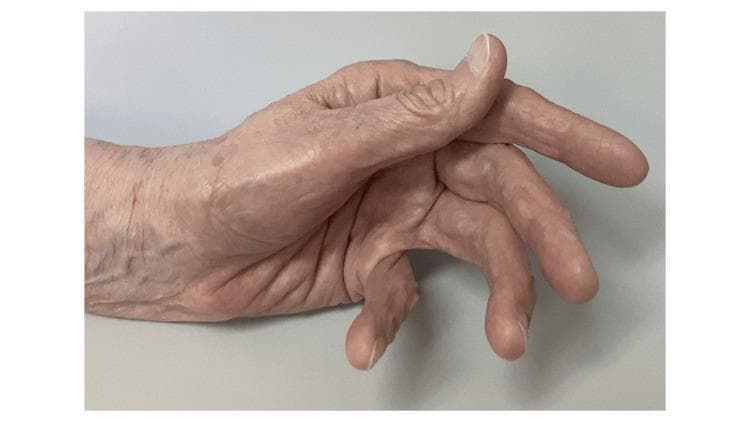 This clinical photograph displays a positive Trousseau sign of latent tetany in a human hand, typically associated with hypocalcemia. The image demonstrates a characteristic carpopedal spasm induced by ischemia (such as after blood pressure cuff inflation). Key visual features include the 'main d'accoucheur' (obstetrician's hand) posture, characterized by flexion at the wrist, flexion at the metacarpophalangeal (MCP) joints, extension of the interphalangeal (IP) joints, and marked adduction of the thumb and fingers toward the palm. The skin on the dorsal surface of the hand shows visible aging, with prominent wrinkling and slight thinning of the dermis. This sign is a critical diagnostic physical exam finding in endocrinology and internal medicine, indicating neuromuscular irritability. The clinical context suggests an electrolyte imbalance, likely secondary to medications like denosumab or dasatinib as mentioned in associated records.