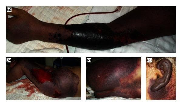 This composite clinical photograph series illustrates extensive, sharply demarcated purpura fulminans across multiple anatomical regions in a patient. (a) The left arm demonstrates a progression from discrete petechial and purpuric spots distally to large, confluent, dark purple and black patches proximally, suggestive of full-thickness skin necrosis and deep tissue ischemia. (b) The left lower limb shows massive, deep violaceous discoloration with a large central ulcerated area exposing subcutaneous tissue, indicating advanced hemorrhagic necrosis. (c) The buttocks present a mottled, retiform pattern of purpuric patches with varying intensities of erythema and cyanosis. (d) The left ear displays diffuse, dark purplish discoloration involving the entire pinna, a classic finding in severe systemic coagulopathies. Collectively, these images illustrate the typical visual manifestations of purpura fulminans, characterized by rapidly progressive, painful, cutaneous hemorrhage and necrosis associated with disseminated intravascular coagulation (DIC). The presentation is critical for educational indexing in dermatology and critical care, focusing on the recognition of life-threatening dermatological emergencies.