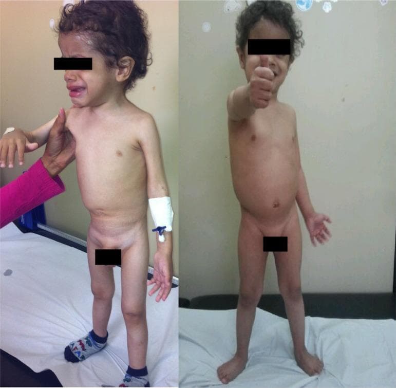 Clinical photograph comparison of a pediatric patient (Patient 2) demonstrating recovery from severe protein-calorie malnutrition (PCM). The left panel shows the initial consultation, depicting clinical signs of marasmus: profound emaciation, loss of subcutaneous fat, visible rib cage, sunken abdomen, and thin extremities. The child exhibits distressed affect (crying) and is seen with a peripheral intravenous catheter on the left arm. The right panel, taken two months later following a high-calorie and high-protein diet, shows significant nutritional recovery. Notable changes include increased muscle mass, restoration of subcutaneous fat stores across the torso and limbs, a healthy abdominal contour, and an improved emotional state (smiling and giving a thumbs-up). This comparison serves as a clinical illustration of therapeutic response to nutritional intervention in cases of severe malnutrition, often secondary to malabsorption or psychosocial factors like child neglect.