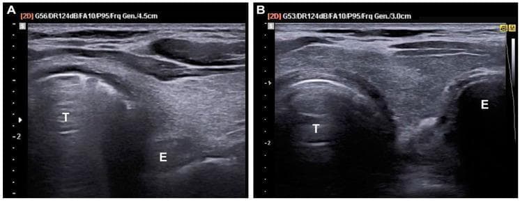 This comparison set of transverse trans-tracheal ultrasound (TTUS) images illustrates sonographic signs used to confirm endotracheal tube placement. Image A demonstrates successful tracheal intubation, characterized by the 'comet tail sign' within the tracheal lumen (T). This reverberation artifact is created by the interface of air and the endotracheal tube. The esophagus (E) remains a collapsed, hypoechoic structure lateral to the trachea. Image B demonstrates an esophageal intubation, evidenced by the 'double ring sign.' In this case, two circular, air-filled structures are visible side-by-side: the anatomical trachea (T) and the distended esophagus (E) containing the misplaced endotracheal tube. Key diagnostic landmarks include the hyperechoic anterior tracheal wall and the relative positioning of the esophagus. These images are essential for emergency medicine and anesthesiology training for rapid, point-of-care airway management verification during cardiac arrest or respiratory failure scenarios.