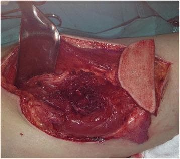 An intraoperative clinical photograph showing the harvest of an anterolateral thigh (ALT) free flap for reconstructive surgery. The image depicts the donor site on the lateral thigh, where a wide surgical incision has exposed the deep anatomical structures. A large metallic retractor is positioned superiorly to provide visualization of the surgical field. The harvested flap is visible, consisting of a paddle of skin and subcutaneous tissue attached to underlying muscle fibers. The donor bed reveals exposed vastus lateralis muscle tissue with evidence of meticulous dissection to isolate the vascular pedicle, likely derived from the descending branch of the lateral circumflex femoral artery. The surgical field shows typical signs of manipulation, including minor localized hemorrhage and exposed fascia. This image demonstrates the technical stage of microvascular flap elevation used in complex head and neck reconstructions, such as glossectomy defects.