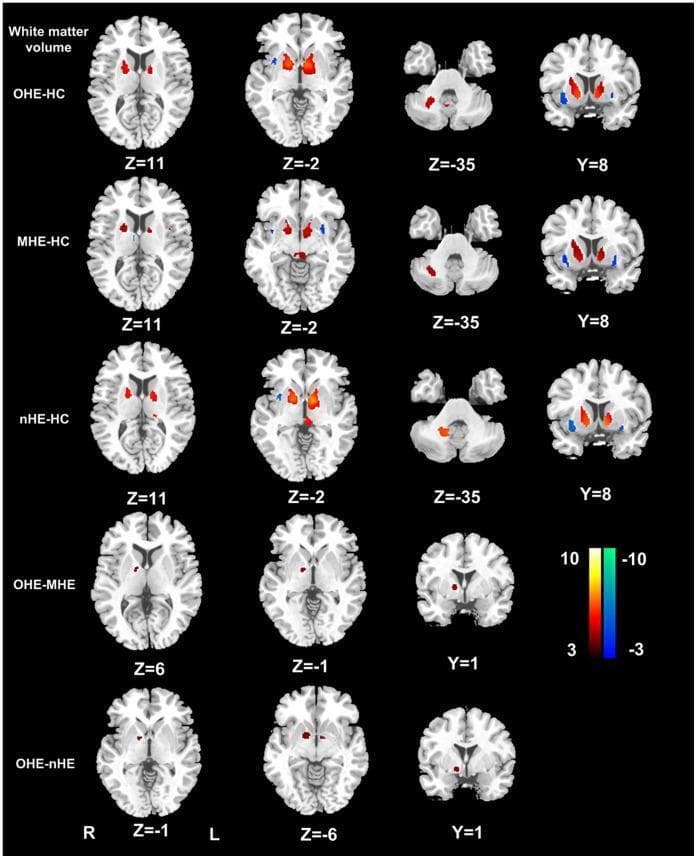 This diagnostic image display consists of axial and coronal MRI brain slices demonstrating voxel-based morphometry (VBM) results of white matter volume (WMV) changes in patients with cirrhosis and varying stages of hepatic encephalopathy (HE). The rows categorize comparisons between overt hepatic encephalopathy (OHE), minimal hepatic encephalopathy (MHE), and non-hepatic encephalopathy (nHE) groups against healthy controls (HC), as well as inter-group comparisons (OHE-MHE and OHE-nHE). A color-coded T-score scale indicates increased WMV in warm colors (red/yellow) and decreased WMV in cool colors (blue). Key findings include significantly increased WMV in the bilateral internal capsules and cerebellum crus (red clusters) across all cirrhotic groups compared to controls, specifically visible at axial slices Z=11, Z=-2, and Z=-35. Decreased WMV is observed in the external capsules (blue clusters), most prominently at slice Y=8. The OHE-MHE and OHE-nHE comparisons highlight localized increases in the internal capsule, suggesting that WMV expansion in these regions correlates with the progression and severity of hepatic encephalopathy.