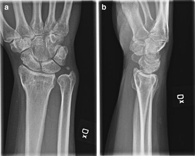 Two radiographic views of a left wrist demonstrate a malunited distal radius fracture in a 48-year-old female. Image (a) is an anterior-posterior (AP) view showing radial shortening and a loss of normal radial inclination. The distal radioulnar joint (DRUJ) appears widened. Image (b) is a sagittal (lateral) view clearly depicting significant dorsal angulation of the distal radial articular fragment, characteristic of a 'dinner-fork' deformity common in malunited Colles-type fractures. This malalignment results in dorsal tilt of the radiocarpal joint surface, affecting the articulation with the carpal bones (scaphoid and lunate). The lunate shows compensatory dorsal subluxation relative to the radial shaft. This imaging provides the clinical basis for a corrective osteotomy to restore anatomical alignment, improve wrist range of motion, and reduce functional limitations.