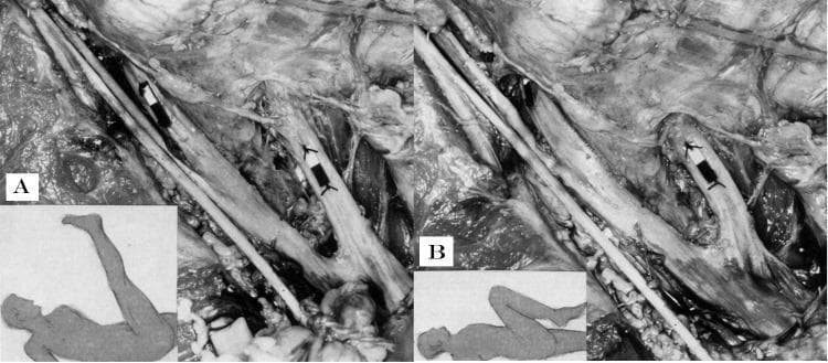 This comparison clinical photograph depicts a cadaveric dissection of the lumbosacral region, specifically focusing on the L5 and S1 nerve roots and their relationship to the neural foramina under different biomechanical stresses. The image is divided into two panels: Panel A illustrates a Straight Leg Raise (SLR) maneuver, showing the lower limb extended and hip flexed. Small paper markers sutured to the nerve root epineurium demonstrate significant distal displacement away from the foramina, indicating the transmission of tensile forces along the sciatic nerve. Panel B shows a 'Sham SLR' where the hip is flexed but the knee is also flexed. In this position, the paper markers remain proximal, with the L5 marker resting within the L4-5 foramen, indicating a lack of longitudinal tension and distal sliding. This visual serves to demonstrate the neurodynamic principles of neural gliding and the mechanical effects of limb positioning on spinal nerve root tension and excursion, which are foundational concepts in orthopedic physical examination and neurophysiology.