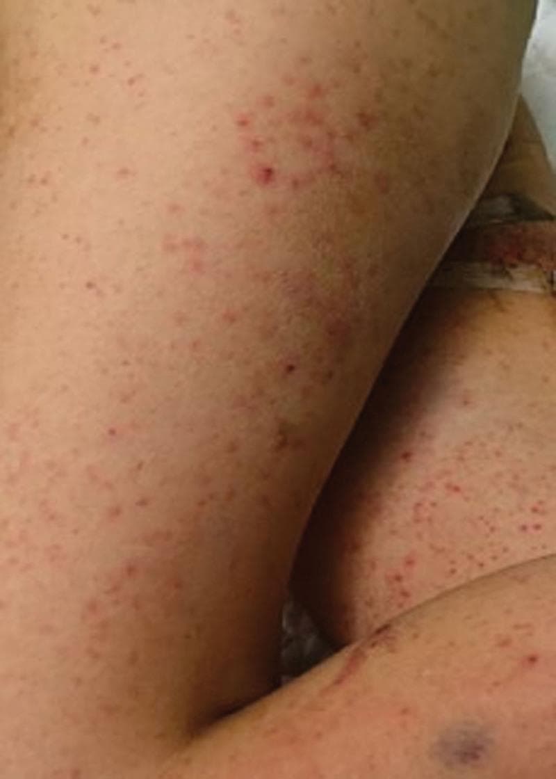 Clinical photograph of a patient's lower extremities exhibiting a nascent skin rash, characterized by a widespread distribution of erythematous macules and papules. The lesions are small, relatively uniform in size (petechial-like), and vary in color from bright red to darker purplish hues, suggesting possible early purpura. The distribution is dense and symmetric across the thighs and lower legs, with occasional clustering of papules. In addition to the primary rash, there is evidence of clinical intervention, including medical adhesive tape and a localized ecchymosis or bruise likely associated with a previous venipuncture or intravenous site. This visual presentation is educationally significant for recognizing the early dermatological manifestations of systemic conditions such as Henoch-Schönlein purpura (IgA vasculitis), sepsis-induced coagulopathy, or viral exanthems in a pediatric or adult hospital setting.