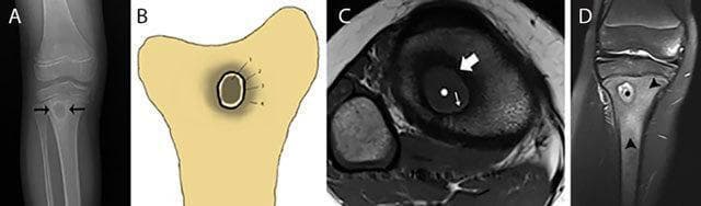 Educational multi-modal imaging of a Brodie abscess in the proximal tibial metaphysis, illustrating subacute osteomyelitis. (A) AP plain radiograph shows a well-defined, oval radiolucent (osteolytic) lesion with a surrounding rim of reactive sclerosis. (B) Schematic illustration correlates the different tissue layers. (C) Axial T1-weighted MRI demonstrates the 'penumbra sign,' characterized by a central low-signal pus collection, a thin hyperintense inner rim of granulation tissue, and an outer hypointense ring of reactive bone sclerosis. (D) Coronal Fat-Sat T2-weighted MRI reveals the central abscess as hyperintense (pus), surrounded by extensive high-signal bone marrow edema in the metaphysis. These images highlight key diagnostic features for identifying intraosseous abscesses, specifically the role of MRI in detecting subtle granulation tissue and surrounding inflammatory changes that distinguish subacute infection from other bone lesions like osteoid osteoma or Langerhans cell histiocytosis.