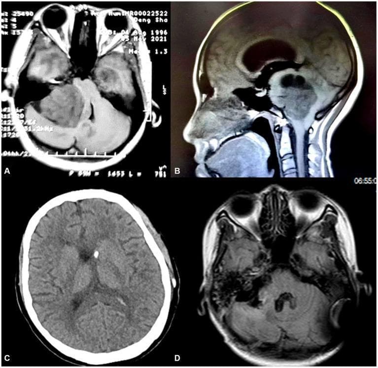 This composite of neuroimaging studies illustrates the progression and surgical management of a vestibular schwannoma. Images A (axial T1-weighted MRI) and B (sagittal T1-weighted MRI) demonstrate a large, well-circumscribed, solid mass measuring approximately 6x5 cm in the right cerebellopontine angle (CPA). The mass exerts a significant mass effect, resulting in severe compression of the brainstem, distortion of the fourth ventricle, and obstructive hydrocephalus. Secondary findings include cerebellar tonsillar herniation. Image C (axial CT scan) shows the placement of a ventriculoperitoneal (V-P) shunt, evidenced by the hyperdense shunt catheter within the enlarged ventricles, which are beginning to show signs of decompression. Image D (postoperative axial T1-weighted MRI) confirms the complete surgical resection of the CPA tumor, restoration of the normal anatomy of the brainstem and posterior fossa, and resolution of the associated hydrocephalus. The case highlights the diagnosis of acoustic neuroma and the staged surgical approach involving intracranial pressure management followed by definitive tumor excision.