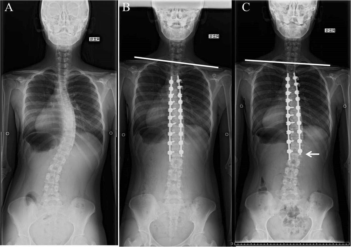 This set of three standing posteroanterior (PA) spinal radiographs demonstrates the surgical management and longitudinal follow-up of adolescent idiopathic scoliosis (AIS). Panel A (preoperative) shows a primary right-convex thoracic curve and a secondary left-convex lumbar curve, resulting in significant coronal imbalance and shoulder asymmetry. Panel B (immediate postoperative) shows the result of posterior spinal fusion using bilateral pedicle screw (PS) constructs extending from the upper thoracic to the lower thoracic/upper lumbar vertebrae. A horizontal line across the clavicles highlights the postoperative improvement in shoulder balance, although some residual tilt persists. Panel C (two-year follow-up) illustrates the long-term stability of the hardware and correction. A white arrow points to the 'distal adding-on' phenomenon, where a new curve develops immediately below the lowest instrumented vertebra (LIV). This compensatory mechanism is shown in relation to the achievement of a level shoulder balance, represented by the horizontal line being parallel to the top of the frame. These images serve as an educational example of thoracic curve correction, postoperative postural adaptation, and common radiographic phenomena following spinal instrumentation.