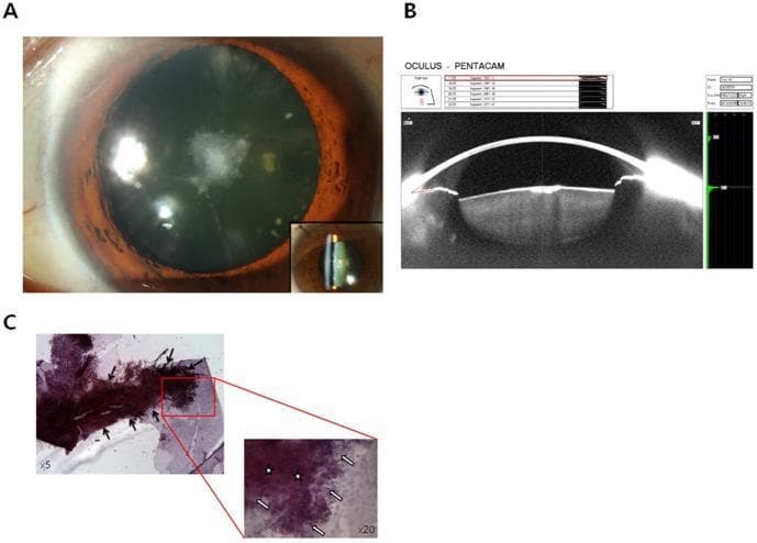This composite ophthalmological figure illustrates the clinical and histopathological features of an anterior polar cataract (APC). Panel A presents a slit-lamp photograph showing a central, irregular white-grey opacity located directly beneath the anterior lens capsule, with an inset demonstrating the focal nature of the opacity within the slit beam. Panel B displays a Scheimpflug imaging scan (Pentacam) which provides a cross-sectional density map, confirming the focal hyperreflectivity at the anterior lens pole. Panel C shows light microscopy of the excised anterior capsule using H&E or similar staining. The low-power view (x5) reveals a multilamellar arrangement with distinct collagenous aggregations (black arrows). The high-power inset (x20) highlights proliferative changes in the lens epithelial cells (open arrows) and dense collagenous deposits (stars), illustrating the fibrotic transdifferentiation characteristic of this cataract type. The material is intended for advanced medical education regarding lens pathology and diagnostic imaging in ophthalmology.