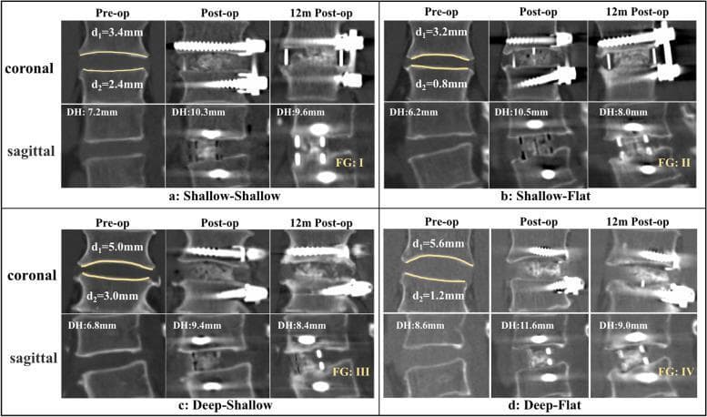 This diagnostic image consists of a series of coronal and sagittal CT scans illustrating four distinct intervertebral space (IVS) morphologies and their radiological outcomes following Oblique Lateral Lumbar Interbody Fusion (OLIF). The images are categorized into four types: (a) Shallow-Shallow, (b) Shallow-Flat, (c) Deep-Shallow, and (d) Deep-Flat, based on endplate concavity depth (ECD) of the L4 inferior and L5 superior endplates. Each category displays three time points: pre-operative, immediate post-operative, and 12 months post-operative. Key metrics shown include disc height (DH), ECD measurements (d1, d2), and Bridwell fusion grades (FG). The Shallow-Shallow type demonstrates optimal outcomes with FG: I and stable DH. In contrast, the Deep-Flat type shows significant DH loss and poor fusion (FG: IV), indicating cage subsidence. The comparison highlights the clinical significance of endplate morphology in predicting subsidence and successful arthrodesis. Visible instrumentation includes interbody cages and pedicle screws. This educational material is suitable for orthopedic and neurosurgical curriculum focusing on spinal biomechanics and fusion outcomes.