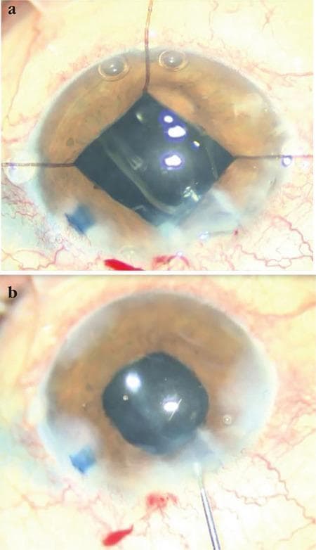 Two-panel clinical photograph capturing stages of a phacoemulsification cataract surgery with intraocular lens (IOL) implantation. Panel (a) illustrates an intraoperative view where four iris retractors are deployed to maintain a mechanical pupillary dilation, creating a characteristic square-shaped pupillary aperture. This technique is typically used in cases of small pupil syndrome or posterior synechiae. Within the pupillary opening, the surgical field is visible with multiple light reflections and evidence of Trypan blue staining of the capsule. Panel (b) shows the postoperative or end-of-procedure state with the iris retractors removed and the pupil returning to a more natural, circular morphology. A clear, foldable IOL is seen centrally positioned within the capsular bag in the posterior chamber. A surgical instrument remains visible at the limbal incision site in the lower right quadrant. The surrounding sclera shows expected postoperative conjunctival injection. The images demonstrate ophthalmic surgical management of complicated cataracts using iris expansion devices.