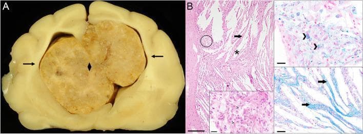 Educational medical composite featuring gross pathology and histopathology of a cerebral cholesterol granuloma. Panel A shows a transverse gross brain section containing a large (2.0 x 2.0 x 2.5 cm), yellowish-grey, lobulated intraventricular mass. The mass almost completely fills the dilated lateral ventricles, causing disruption of the interventricular septum and significant mass effect with compression of the adjacent cerebral parenchyma (indicated by arrows). Panel B displays light microscopy of the mass revealing granulomatous inflammation. Key features include numerous acicular, optically empty 'cholesterol clefts' (*) and prominent fibrous septae (arrows). High-magnification inserts demonstrate a dense population of foamy, hemosiderin-laden macrophages. Specialized stains facilitate diagnosis: Prussian blue (top right) highlights positive blue-stained hemosiderin deposits within macrophages, indicating chronic hemorrhage; Azan stain (bottom right) highlights blue-stained collagen within the fibrous septae. The presentation is characteristic of a cholesterol granuloma originating from the choroid plexus, typically seen in cases of chronic ventricular hemorrhage or obstructive hydrocephalus.