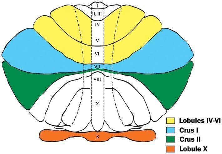 Anatomical diagram representing a Larsell flatmap of the human cerebellum, color-coded to highlight four specific regions of interest (ROIs) for clinical study. The flatmap unfolds the cerebellar cortex into a two-dimensional view to illustrate the relationship between lobules and fissures. The yellow-shaded area identifies hemispheric lobules IV-VI in the anterior and superior posterior lobes, bordered by the preculminate and superior posterior fissures. The light blue region represents Crus I, delineated by the superior posterior and horizontal fissures. Below this, the green-shaded area indicates Crus II, bounded by the horizontal and ansoparamedian fissures. At the inferior-most pole, the orange region highlights Lobule X (flocculonodular lobe), separated by the posterolateral fissure. The central vermis is labeled with Roman numerals I-X, showing the midline organization. This visual aid is primarily used in neuroanatomical research and clinical imaging studies to define boundaries for stereological assays, particularly in investigations related to Purkinje cell density and neurodevelopmental disorders like autism.