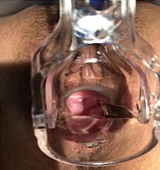 This clinical photograph displays a pelvic examination using a transparent plastic Graves speculum. The focus is on the vaginal vault of a patient who previously underwent a total laparoscopic hysterectomy. The image illustrates a well-healed vaginal cuff, characterized by pink, healthy-appearing mucosal tissue at the apex with a clear surgical line showing complete closure. There is no evidence of erythema, discharge, or recurrent dehiscence. A metal surgical instrument is visible within the speculum, used for retraction or manipulation to enhance the view of the vaginal apex. The surrounding external genitalia and perineum appear normal, with standard skin pigmentation and typical distribution of pubic hair. This image serves as an educational reference for normal post-operative healing following the repair of a vaginal cuff dehiscence, demonstrating the expected integrity and caliber of the vaginal canal after successful surgical intervention.
