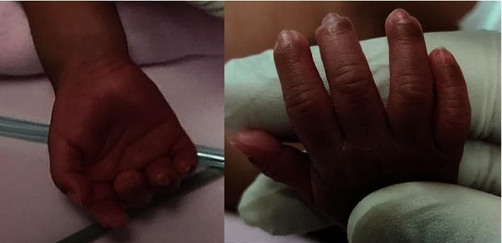 Clinical photograph of a neonate's right hand shown in two views: a palmar view (left) and a dorsal view (right). The hand belongs to an extremely premature infant (24 weeks gestation). The images demonstrate the complete resolution of previously documented digital ischemia. The skin displays a healthy, uniform reddish-pink hue across all digits and the palm, with no residual cyanosis, pallor, or bluish discoloration. The distal phalanges of the second, third, and fourth fingers appear well-perfused with intact skin integrity and no evidence of tissue necrosis, ulceration, or scarring. The soft tissue contour is normal for a preterm infant, showing no signs of significant edema or atrophy. These images illustrate successful recovery and reperfusion in neonatal vascular compromise, potentially following medical interventions like topical nitroglycerin.