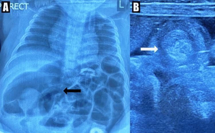 This composite diagnostic image demonstrates a case of pediatric small bowel obstruction caused by intussusception. Panel A shows an anteroposterior (AP) erect abdominal X-ray of a child. It reveals multiple dilated, air-filled loops of small bowel throughout the abdomen, indicative of a distal obstruction. A black arrow points to a particularly distended segment in the right upper quadrant. Panel B shows a corresponding abdominal ultrasound in transverse section. A white arrow highlights the 'target' or 'donut' sign, which is a pathognomonic finding for intussusception. This sign appears as a concentric, multilayered mass representing the intussusceptum within the intussuscipiens. These imaging modalities together illustrate the classic radiological workup for pediatric abdominal emergencies, showcasing the bowel gas patterns seen on radiography and the specific sonographic features used to confirm the diagnosis of intussusception.