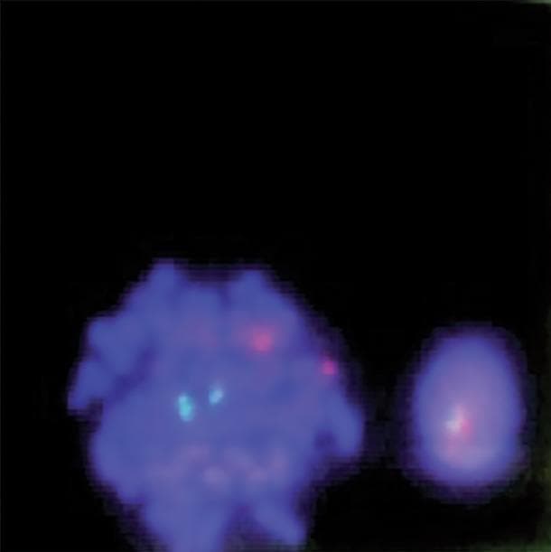 This diagnostic image displays a fluorescence in situ hybridization (FISH) analysis of human bone marrow cells, used primarily for detecting the BCR-ABL1 gene fusion associated with Chronic Myeloid Leukemia (CML). The image shows two blue-stained nuclei (DAPI) against a dark background. On the left, a larger metaphase cell exhibits a normal signal pattern with two distinct cyan/green signals and two distinct red signals (2G2R), representing the normal location of the ABL1 and BCR genes on their respective chromosomes. On the right, a smaller interphase cell demonstrates a fusion signal where a red and a cyan/green signal overlap or are closely apposed, indicative of a chromosomal translocation. This visual is a key educational tool for demonstrating molecular cytogenetics, specifically the dual-color, dual-fusion probe technique used in hematopathology to identify the Philadelphia chromosome.