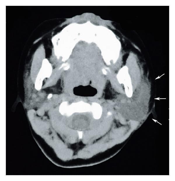 This diagnostic image is an axial computed tomography (CT) scan of the neck at the level of the mandible, demonstrating clinical findings of sialadenitis. The primary focus is the left parotid gland, which is significantly enlarged and swollen compared to the contralateral side. The left parotid exhibits a heterogeneous parenchymal density and ill-defined margins, indicated by white arrows, which suggest active inflammation and adjacent soft tissue edema. In contrast, the right parotid gland appears relatively normal in size with more uniform density. Key anatomical structures visible include the mandibular rami, the base of the tongue, the oropharynx, and the cervical vertebrae. The image serves as an educational example of inflammatory pathology of the salivary glands, highlighting the use of cross-sectional imaging to assess glandular swelling, tissue plane blurring, and potential complications such as abscess formation in cases of acute sialadenitis or mumps-related parotitis.