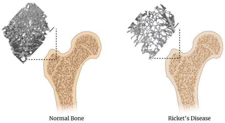 This comparison diagram illustrates the architectural differences between normal bone and bone affected by Rickets (osteomalacia) at the proximal femur. The image consists of two panels: 'Normal Bone' on the left and 'Ricket's Disease' on the right. Each panel features a cross-sectional anatomical diagram of the femoral head and neck, paired with a high-magnification micro-CT or radiographic inset demonstrating trabecular microarchitecture. In the normal bone, the trabeculae are thick, highly interconnected, and densely packed, indicating robust mineralization and structural integrity. Conversely, the Ricket's disease panel shows a significant reduction in bone mineral density. The trabeculae are visibly thinner, sparser, and exhibit increased porosity with larger marrow spaces, reflecting impaired mineralization and ossification typical of Vitamin D deficiency. A 1 mm scale bar is provided for reference. This educational visual is designed to highlight the pathophysiological impact of metabolic bone diseases on skeletal microstructure, useful for clinical training in orthopedics, endocrinology, and radiology.