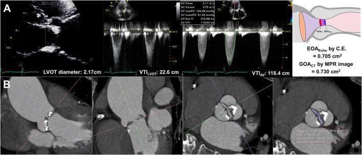 This composite medical image illustrates the comparative assessment of aortic stenosis severity using echocardiography and cardiac computed tomography (CT). Panel A (upper section) showcases the echocardiographic continuity equation method. It includes a parasternal long-axis view for measuring the left ventricular outflow tract (LVOT) diameter (2.17 cm), alongside pulsed-wave and continuous-wave Doppler tracings. Quantitative data displayed include LVOT velocity-time integral (VTILVOT: 22.6 cm), aortic valve velocity-time integral (VTIAV: 118.4 cm), peak velocity (5.11 m/s), and mean pressure gradient (61.04 mmHg), resulting in a calculated effective orifice area (EOAEcho) of 0.705 cm². Panel B (lower section) demonstrates multiplanar reconstructed (MPR) CT imaging. Cross-sectional views of the aortic root and valve reveal significant calcification of the leaflets. Planimetry of the aortic valve area is highlighted with a blue trace, providing a geometric orifice area (GOACT) of 0.730 cm². An accompanying schematic diagram contrasts the functional flow area (EOA) with the anatomical opening (GOA). The image is designed for cardiology education regarding the diagnostic evaluation of valvular heart disease.
