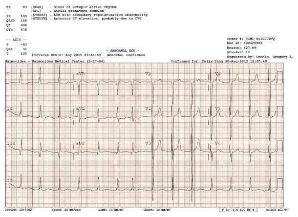 A standard 12-lead electrocardiogram (ECG) demonstrating several diagnostic abnormalities relevant to cardiovascular pathology. The tracing shows a rhythm characterized as ectopic atrial rhythm with visible atrial premature complexes (APCs). Voltage criteria for left ventricular hypertrophy (LVH) are met, notably evidenced by deep S waves in the right precordial leads (V1-V3) and tall R waves in the left precordial leads (V4-V6). Associated secondary repolarization abnormalities are present, including ST-segment elevation in the anterior leads (V1-V3) and T-wave inversions in the lateral leads, which are commonly associated with LVH-related strain patterns. The PR interval appears borderline prolonged, and the QTc is noted as 470 ms. This diagnostic image illustrates the electrical manifestations of structural heart disease, specifically left ventricular hypertrophy and atrial ectopy, in a clinical context of secondary hypertension and end-stage renal disease.